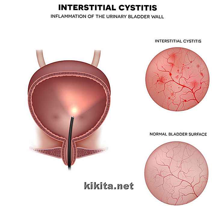 13 Gezondheidsfeiten over interstitiële cystitis