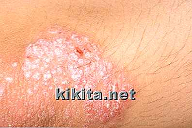 Tekenen en symptomen van niet-melanoom huidkanker