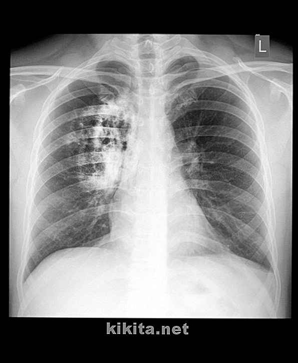 Adem in deze 6 feiten over pulmonale fibrose